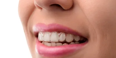 Элайнеры (капы для выравнивания зубов) в Омске недорого, цены в  стоматологии Ортодонт-центр