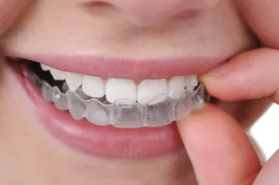 Повернутые зубы – лучше брекеты или капы для выравнивания зубов? – Альянс  бьюти-стоматологов, Москва