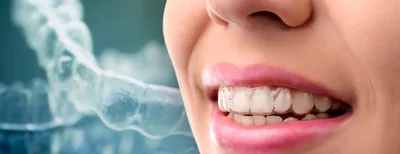 Капы для выравнивания зубов•Элайнеры - Цена в Amel Smart Clinic ᐉ Днепр