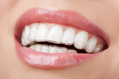 Элайнеры для Выравнивания Зубов в Санкт-Петербурге - Записаться на лечение  прикуса
