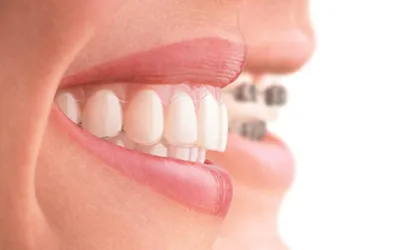 Капы для выравнивания зубов в Киеве в стоматологии «Фортуна»