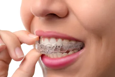 Как помогают трейнеры для выравнивания зубов у взрослых?