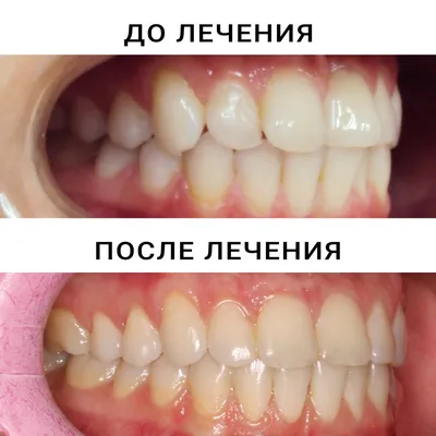 Стоимость кап для зубов в Красноярске