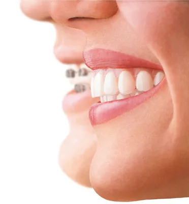 Элайнеры для выравнивания зубов для взрослых и детей/ Трейнер антихрап, капа  стоматологическая прозрачная от бруксизма, храпа - купить с доставкой по  выгодным ценам в интернет-магазине OZON (1210499522)