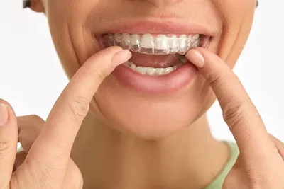 Элайнеры для Выравнивания Зубов в Санкт-Петербурге - Записаться на лечение  прикуса