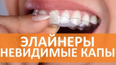 Прозрачные каппы для выравнивания зубов отзывы и цены в Москве