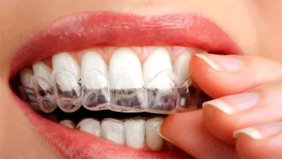 Капы для выравнивания зубов – как пользоваться и сколько носить - iOrtho  Center - ортодонтические клиники в Москве и Санкт Петербурге