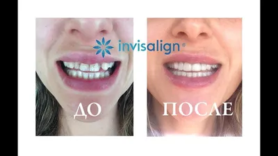 ДО и ПОСЛЕ элайнеры (капы) Инвизилайн (Invisalign) | Результат и отзыв -  YouTube