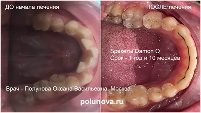 Капы детские для выравнивания зубов и исправления прикуса