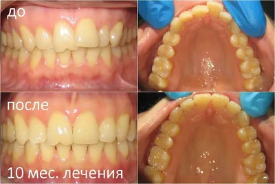Лечение дисфункции зубочелюстной системы, установка виниров, имплантация  зубов. Фото до и после