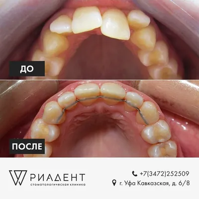 Фото до и после стоматологии | Клиника Damas Clinic