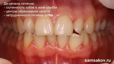 Капы для выравнивания зубов детям: исправление прикуса детскими элайнерами,  цена на установку и отзывы