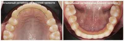 Ночные капы для зубов - цена от 7500 ₽ в Санкт-Петербурге | клиника Медикор