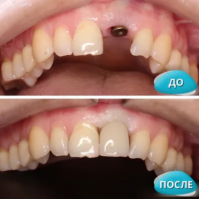 Устранение скученности зубов капами для исправления прикуса 3D Smile