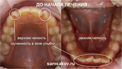 Основные правила ношения ортодонтической капы. - Вита 3D