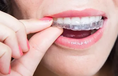 Лечение каппами Invisalign