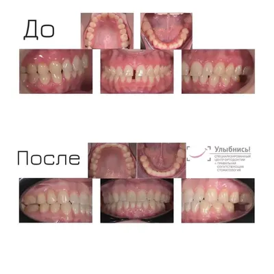 Элайнеры и капы для выравнивания зубов | Стоимость в Минске