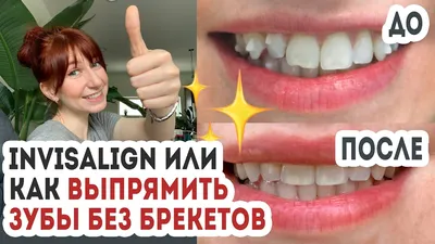 ДО и ПОСЛЕ | элайнеры (капы) Инвизилайн (InvisAlign) | Отзыв, мои  результаты и цена - YouTube