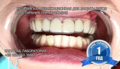 Капа для защиты зубов от стирания
