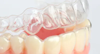 Капы для выравнивания зубов INVISALIGN во доступным ценам | Изготовление  кап для выравнивания зубов бех брекетов