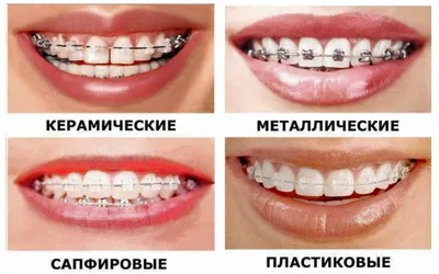 Капы или брекеты: что выбрать для выравнивания зубов в ортодонтической  стоматологии