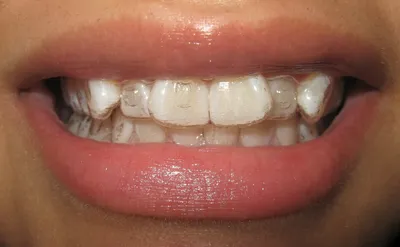 Капы и их удобство для выравнивания зубов, виды и рекомендации |  Стоматология \"Имплант-Эксперт\" | Дзен