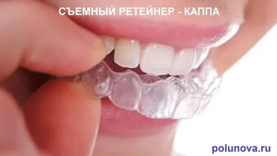 Когда вместо брекетов лучше применять прозрачные капы – клиника  Ортодонтика, Москва
