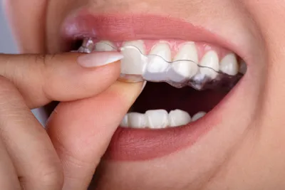 Ортодонтия. Капы 3D Smile
