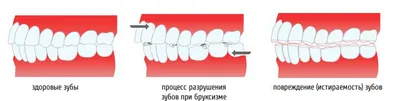 Индивидуальная каппа для зубов: изготовление в Минске