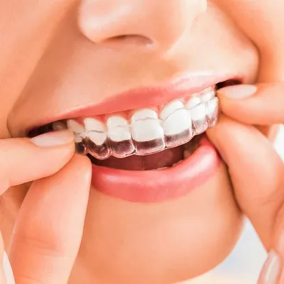 Элайнеры в Киеве ➡️ Ортодонтические капы для выравнивания зубов ✓ Клиника  Доброго Стоматолога
