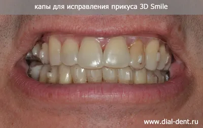 Выравнивание зубов капами 3D Smile | Стоматология Диал-Дент | Дзен