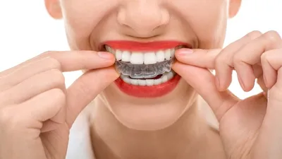 Лучшие капы для отбеливания зубов: рейтинг топ-10 эффективных и недорогих  средств по версии КП
