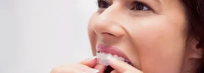Повернутые зубы – лучше брекеты или капы для выравнивания зубов? – Альянс  бьюти-стоматологов, Москва