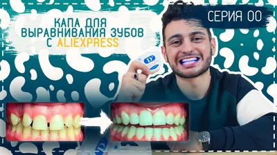 Капы и их удобство для выравнивания зубов, виды и рекомендации |  Стоматология \"Имплант-Эксперт\" | Дзен