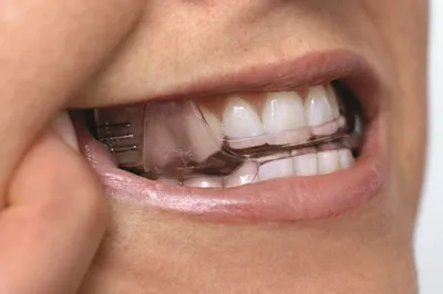 Капа для зубов ретензионная, с перемещением, от бруксизма - «Капа РЕАЛЬНО  помогает мне с зубами❗️Покажу что стало с ней за 7 лет😧 Купила через  интернет в 3 раза дешевле - такую хоть
