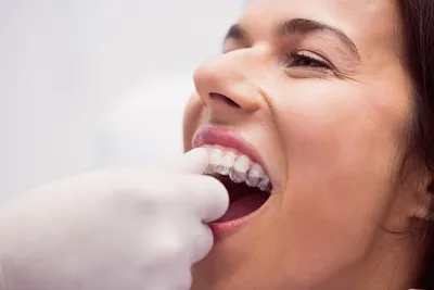 Капы для выравнивания зубов в Киеве в стоматологии «Фортуна»