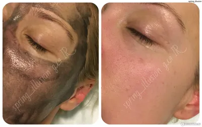 Лазерный пилинг (дермабразия) кожи лица: противопоказания, уход , фото до и  после процедуры