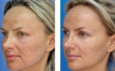 Карбоновый пилинг Spectra Peel — Aging Control в Москве