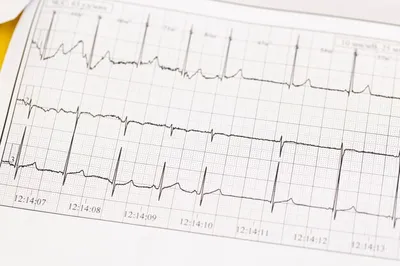 Вид элементов экг или сердце бьется или здоровья печатает на доклад  пациента Стоковое Изображение - изображение насчитывающей внимательность,  данные: 210656649