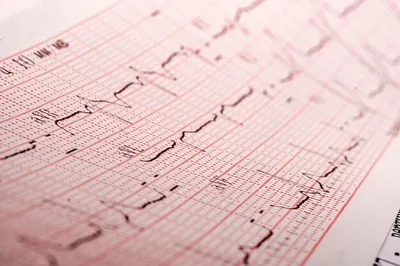 ЭКГ (Электрокардиография) в Уфе – цены, запись на приём в А-Клиник