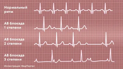 Электрокардиография (ЭКГ) - «Оказывается ЭКГ не такая уж и информативная  диагностика проблем с сердцем, но ей по прежнему верит и скорая, и  кардиологи. Но сделать ЭКГ всегда необходимо. » | отзывы