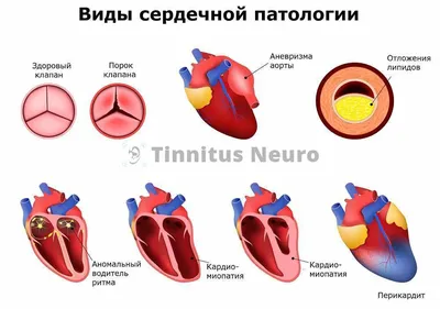 Блокада сердца: причины, классификация, признаки и лечение патологии