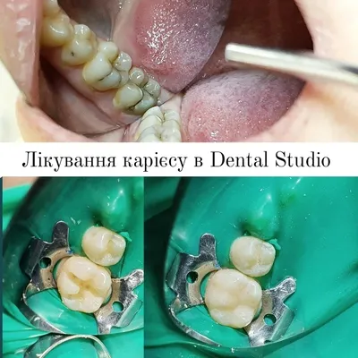 Лечение глубокого кариеса | Стоматология в Запорожье Dental Studio