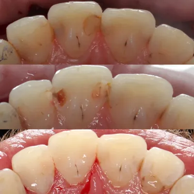 Фото работы до и после — Лечение кариеса