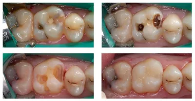 Вторичный кариес: лечение и профилактика, причины и симптомы рецидива  кариеса, цены в Москве