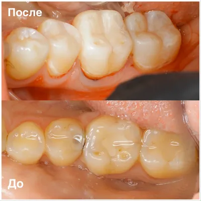 Вторичный кариес 46 и 47 зубов | Примеры работ - фото до и после