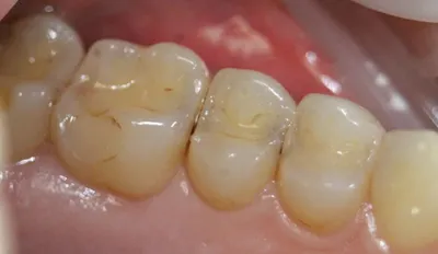 Лечение поверхностного кариеса в Астане – Записаться на лечение зубов в  стоматологии «МЛД»
