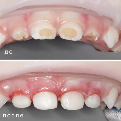 Лечение кариеса, фото до и после, пример работы 42973