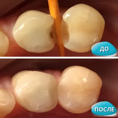 Лечение зубов до и после фото - Центр Семейной Стоматологии в Кожухово