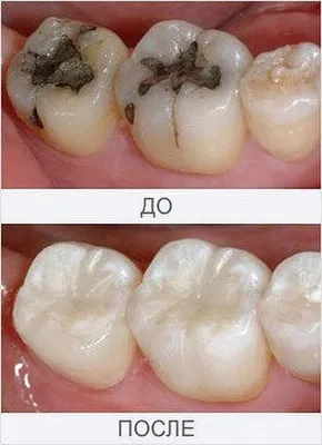 Кариес на контакте: выполненная работа с фото до и после в стоматологии  OneDent
